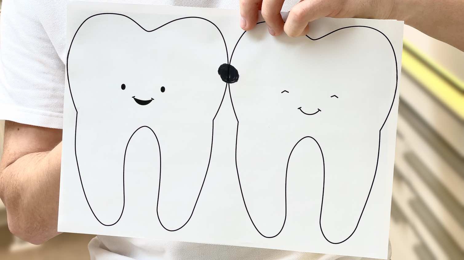 Karies beginnt meist am Kontaktpunkt zwischen den Zähnen