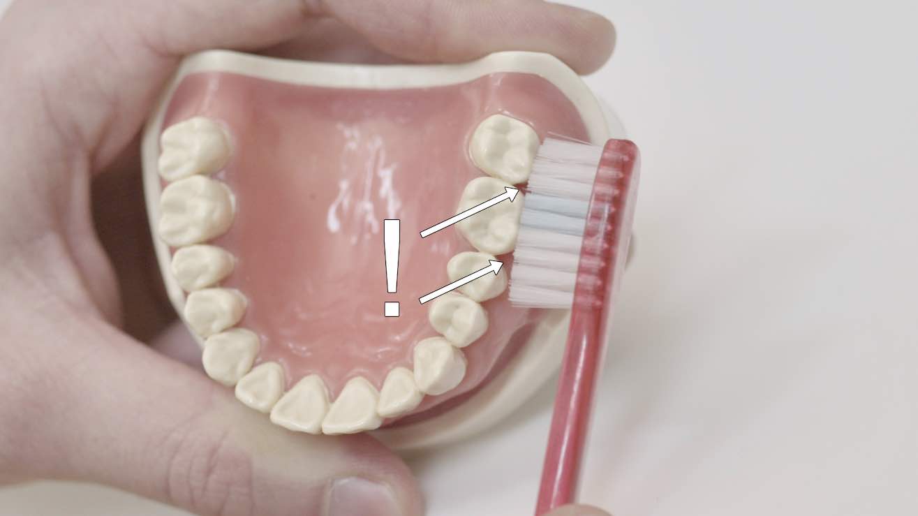 Problemstellen beim Zähneputzen