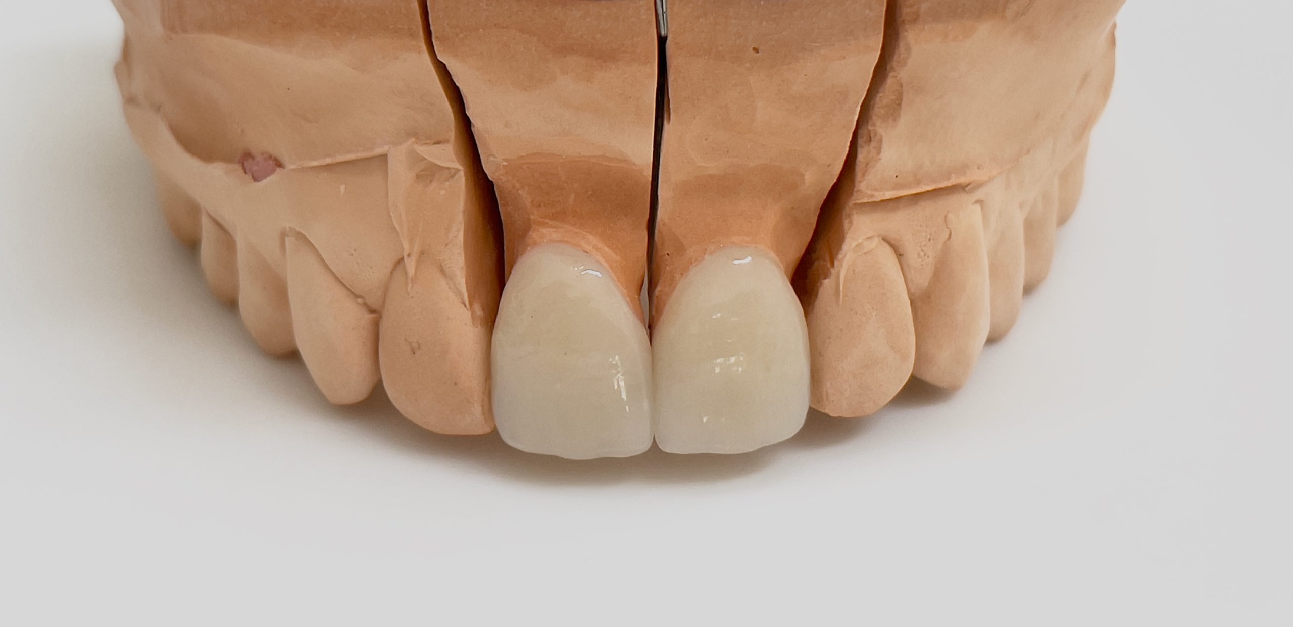 Veneers Wien 1040 Dr. Lukas Hallmann